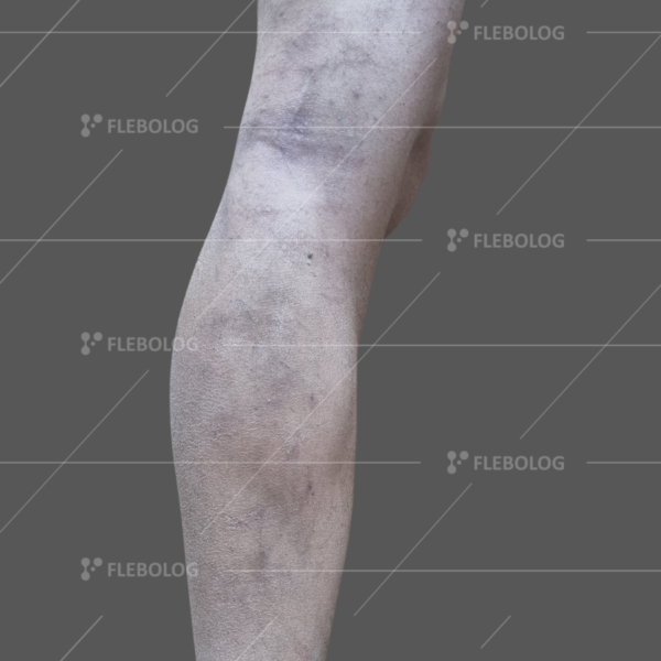 Лечение варикоза до и после - флеболог Барабой, фото 41