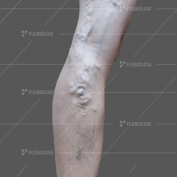 Лечение варикоза до и после - флеболог Барабой, фото 40