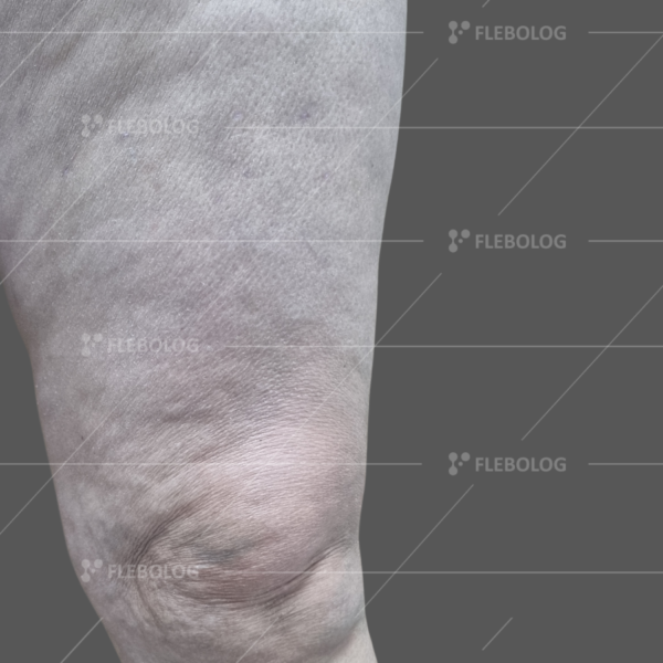 Лечение варикоза до и после - флеболог Барабой, фото 35