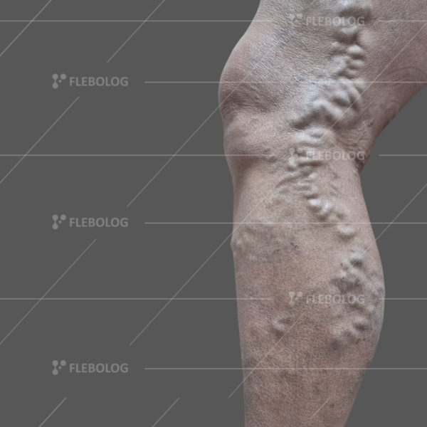 Лечение варикоза до и после - флеболог Барабой, фото 36