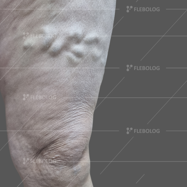 Лечение варикоза до и после - флеболог Барабой, фото 34