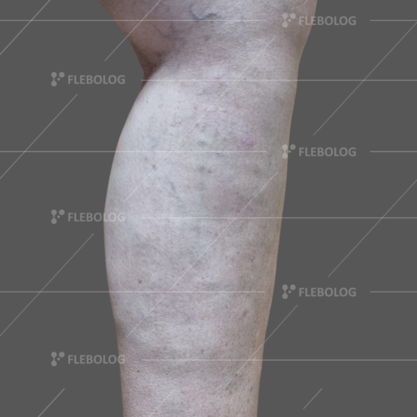 Лечение варикоза до и после - флеболог Барабой, фото 29