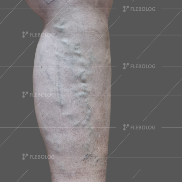 Лечение варикоза до и после - флеболог Барабой, фото 28