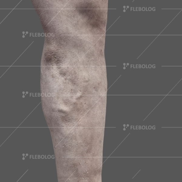 Лечение варикоза до и после - флеболог Барабой, фото 27