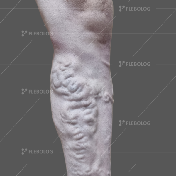 Лечение варикоза до и после - флеболог Барабой, фото 26