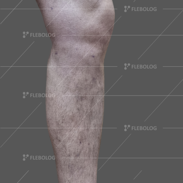 Лечение варикоза до и после - флеболог Барабой, фото 86