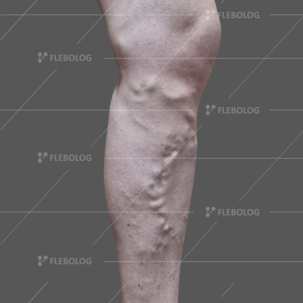 Лечение варикоза до и после - флеболог Барабой, фото 85