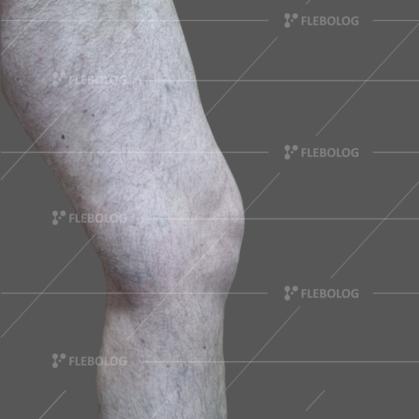 Лечение варикоза до и после - флеболог Барабой, фото 80