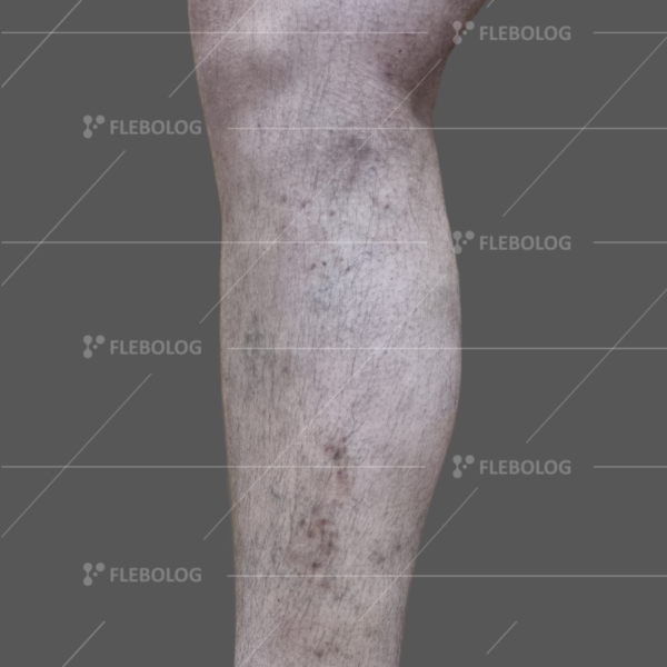 Лечение варикоза до и после - флеболог Барабой, фото 82