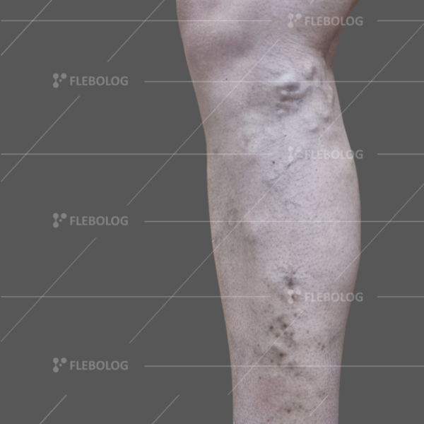 Лечение варикоза до и после - флеболог Барабой, фото 81