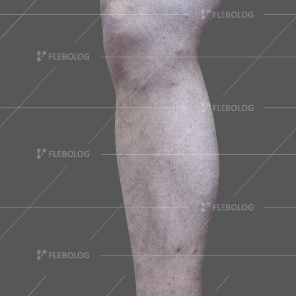 Лечение варикоза до и после - флеболог Барабой, фото 78