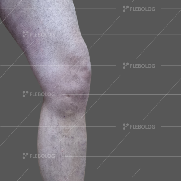Лечение варикоза до и после - флеболог Барабой, фото 76