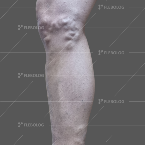 Лечение варикоза до и после - флеболог Барабой, фото 77