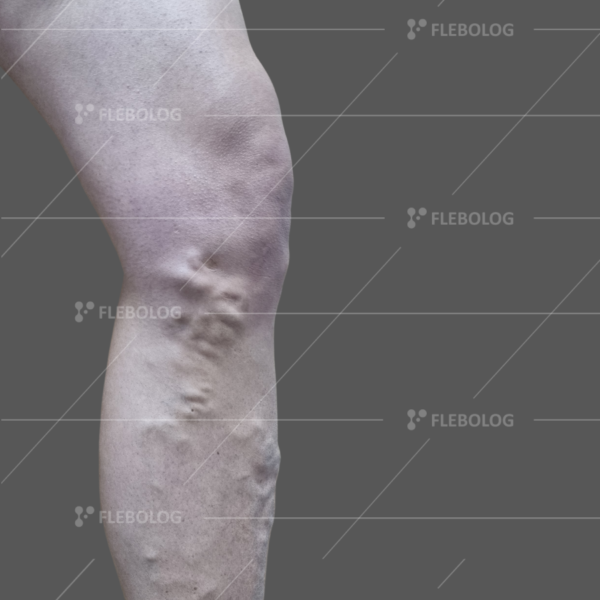 Лечение варикоза до и после - флеболог Барабой, фото 75