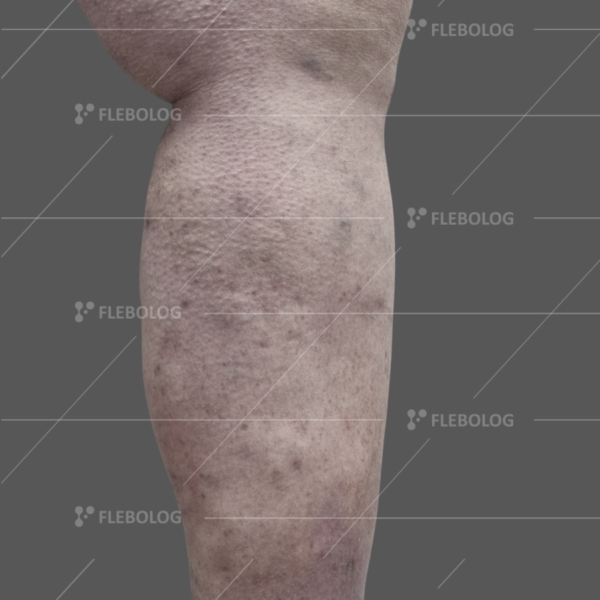 Лечение варикоза до и после - флеболог Барабой, фото 62