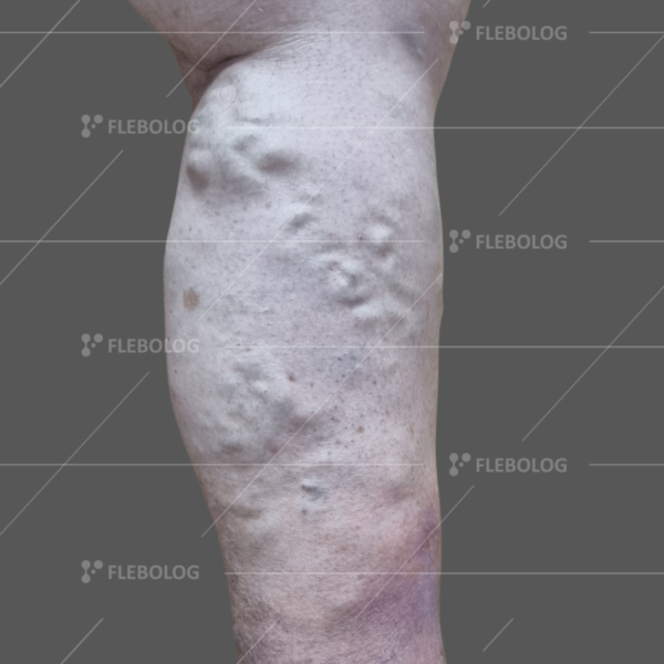 Лечение варикоза до и после - флеболог Барабой, фото 61