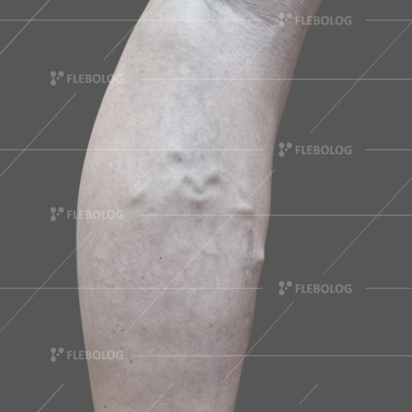 Лечение варикоза до и после - флеболог Барабой, фото 59